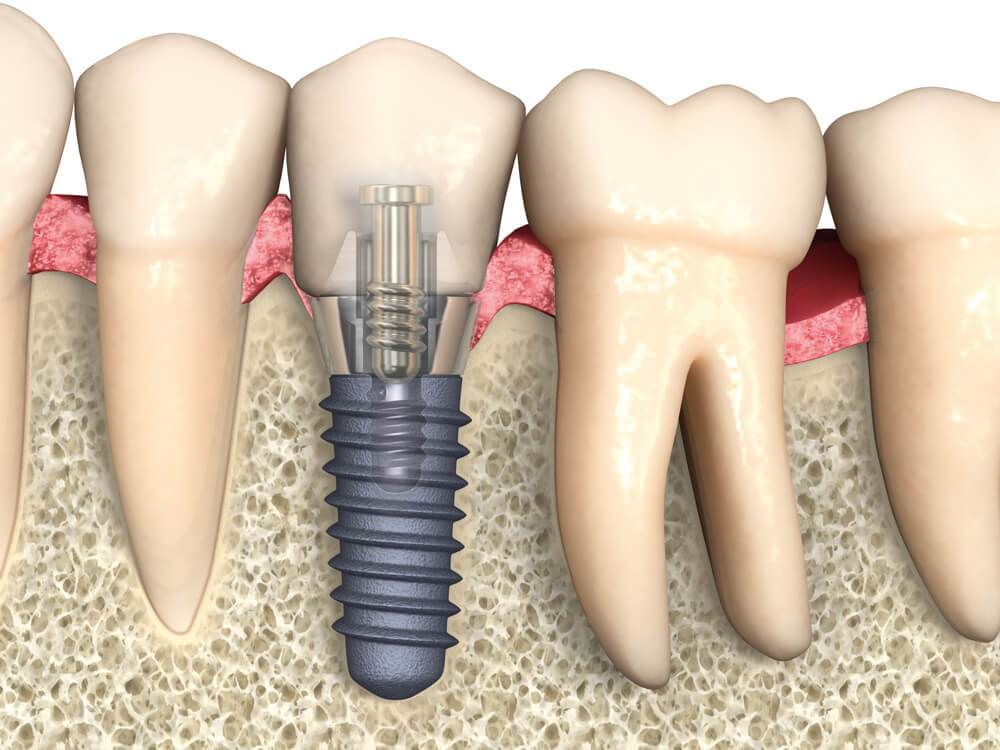 implant-safe-center-werden-implantat