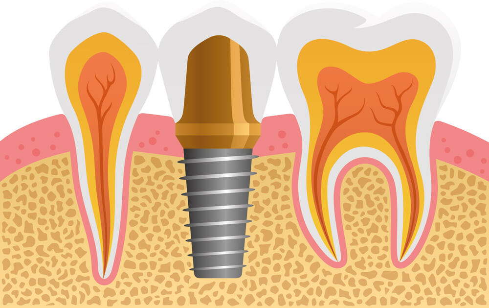 implant-safe-center-werden-implantatillustration1