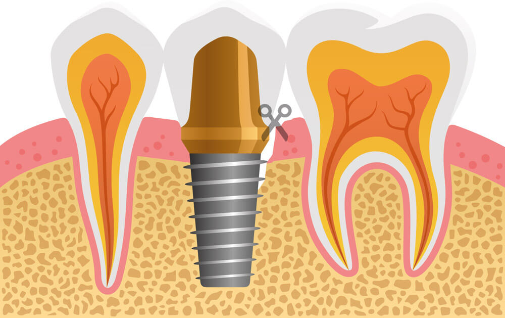 implant-safe-center-werden-implantatillustration2