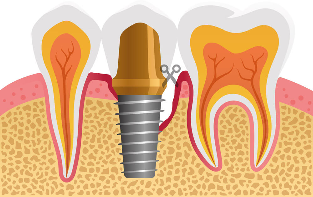 implant-safe-center-werden-implantatillustration3